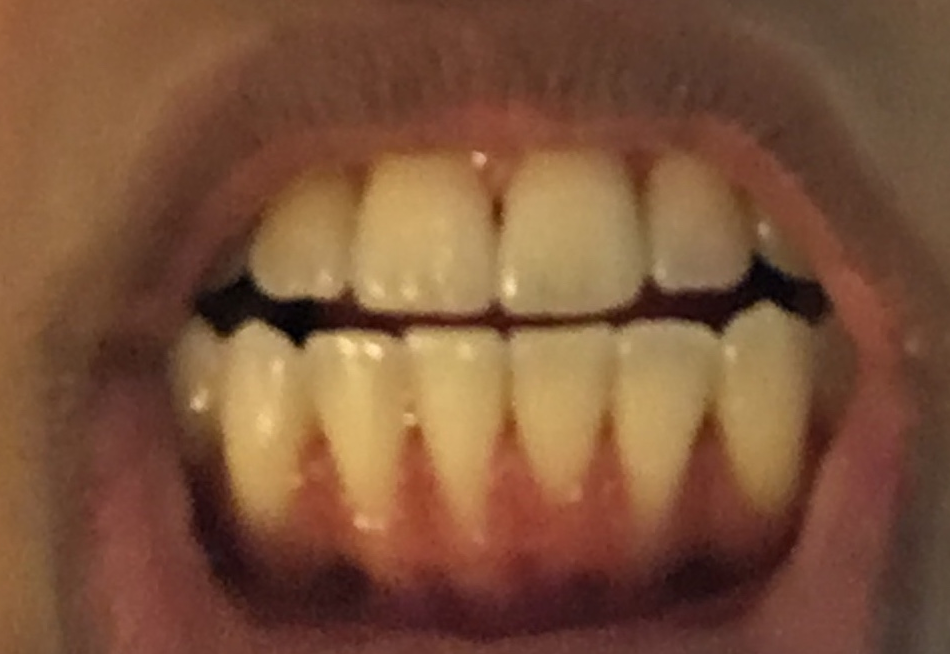 bad gapped teeth