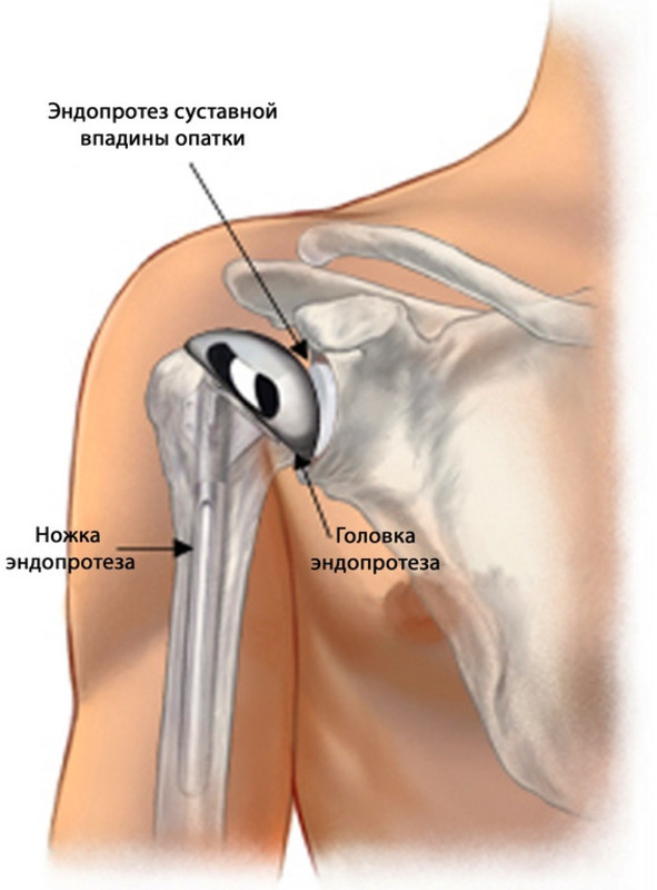 Операция по замене плечевого сустава. Эндопротез плечевого сустава Тотальный реверсивный. Эндопротез головки плечевой кости. Реверсивное эндопротезирование плечевого сустава. Эндопротез шейки плечевой кости.